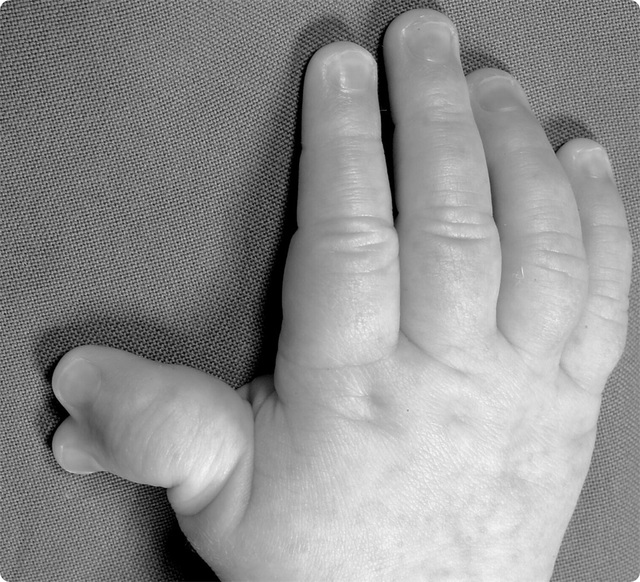 Duimpolydactylie
